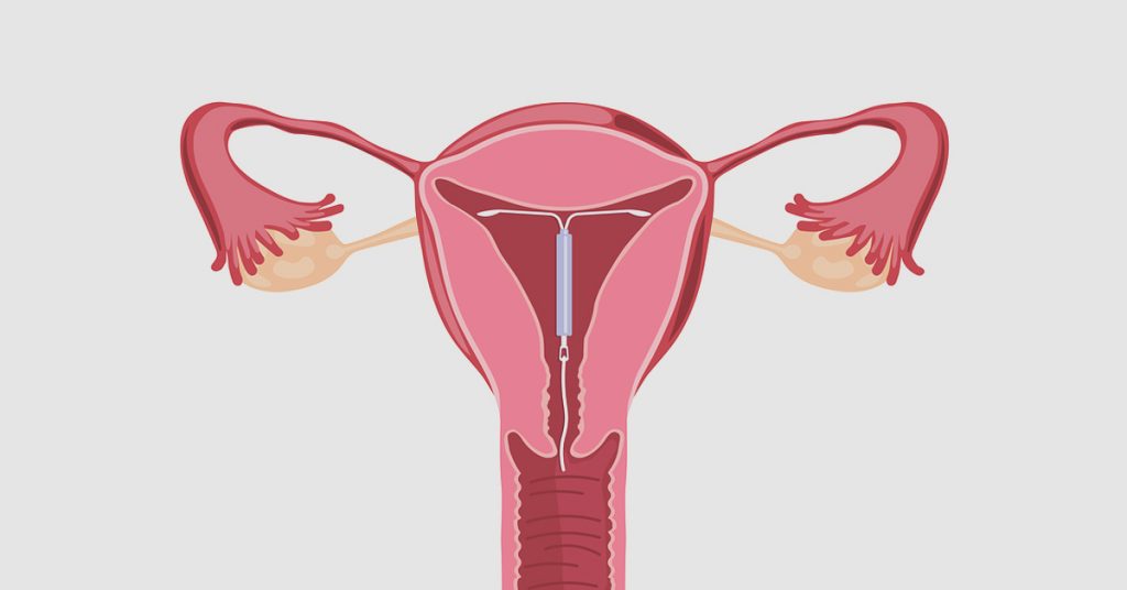mirena-iud-can-cause-potentially-permanent-complications